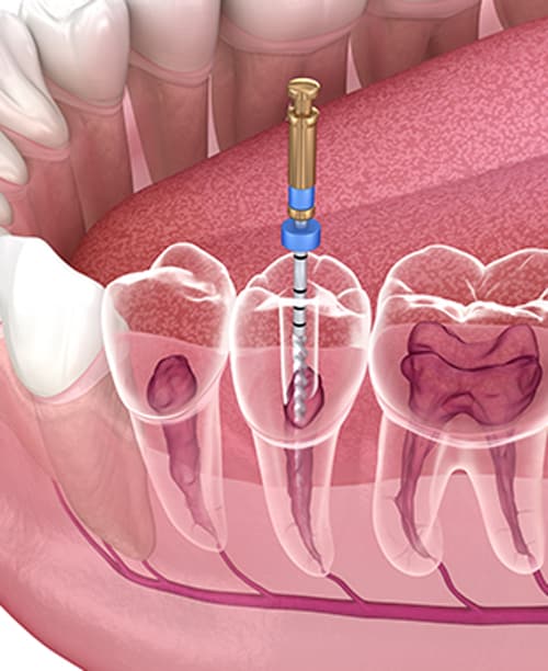 هزینه درمان ریشه دندان